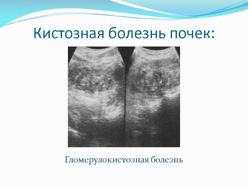 Кистозная болезнь почек: Гломерулокистозная болезнь